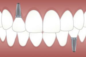 Illustration d'implant dentaire