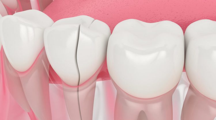 Les différentes solutions pour réparer une dent cassée
