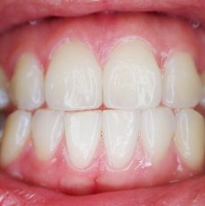 Comment soigner un aphte : causes et traitements